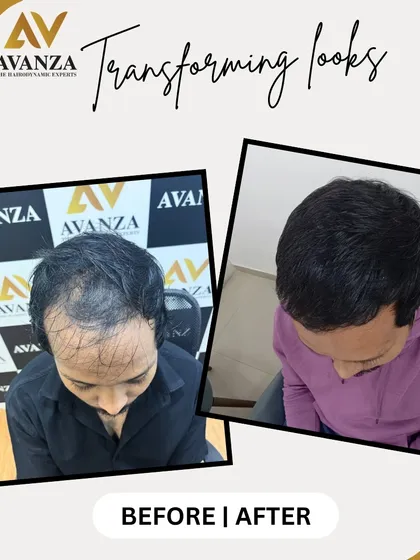 No filters, just real results. This client's hair was restored with a focus on natural density and a soft hairline, creating a look that is both full and believable.