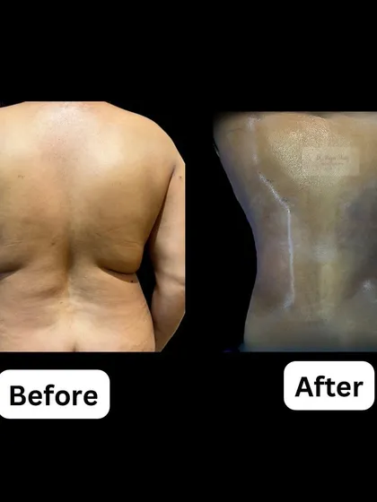 This demonstrates the power of Vaser liposuction combined with BodyTite radiofrequency technology. For this patient, we performed a revision procedure to remove stubborn fat from the back and flanks while tightening the skin, successfully restoring a defined, hourglass waistline.