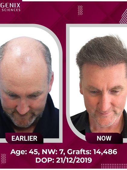 An incredible transformation of a 45-year-old international patient with Grade 7 baldness, who received 14,486 grafts for a full head of hair.