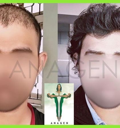High density results from our Biotech Instant Direct Pen FUE technique. The patient's transformation from baldness to a full head of hair is remarkable.