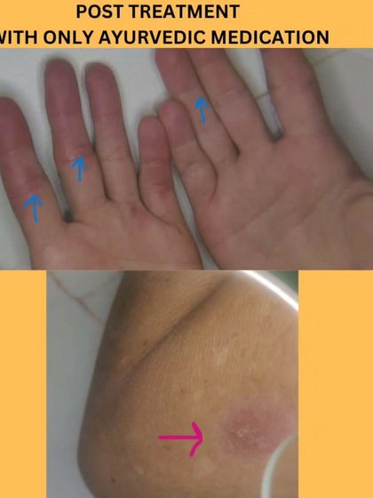 This photo shows the same patient's hands after completing the course of Ayurvedic medication. The lesions have healed, and the skin has cleared up significantly, providing much-needed relief without harsh side effects.