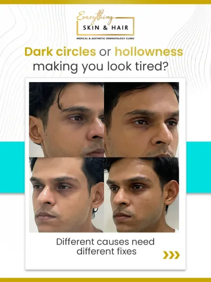 Hollowness and dark circles under the eyes can make you look tired regardless of how much you rest. Here, you can see the significant yet subtle improvement achieved by addressing volume loss, resulting in a brighter and more rested look for my patient.