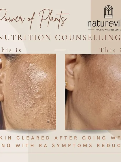 The power of plants is visible. This client was suffering from Rheumatoid Arthritis and after following my protocols, not only did her RA symptoms improve, but her skin cleared up beautifully. Healing happens from the inside out.