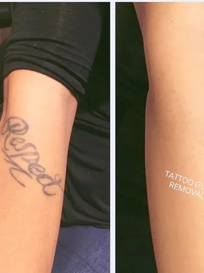 Script tattoos are very common, and I have a lot of experience removing them completely. This is a straightforward example of a 'Respect' tattoo on the forearm being fully cleared.