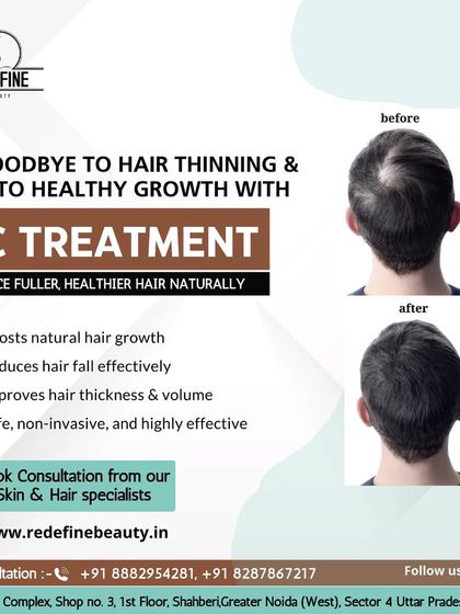 An informational graphic highlighting the key benefits of GFC treatment. It's a safe, non-invasive, and highly effective way to boost natural hair growth, reduce hair fall, and improve hair thickness and volume.