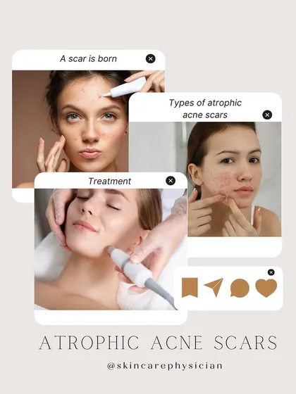 Treating atrophic acne scars is a journey. My goal is to achieve significant improvement, not perfection, often using a combination of procedures over multiple sessions.