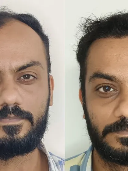 This patient wanted to bring his hairline forward and add density. This before-and-after comparison clearly shows the successful outcome, achieving a fuller look and a more defined facial frame.