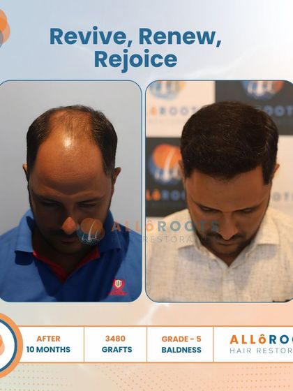Revive, Renew, Rejoice. This 10-month result for a Grade 5 baldness case, using 3480 grafts, shows a complete restoration. The images from all angles prove that a full head of hair is an achievable goal.