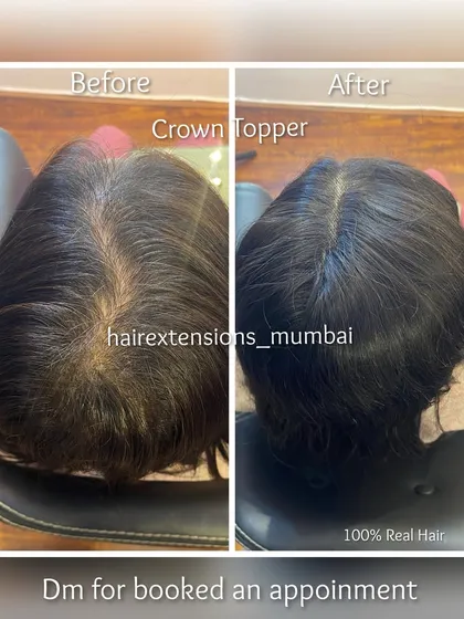 See the immediate difference a crown topper makes. This image contrasts the visible scalp before with the full, natural-looking coverage after application of the 100% real hair piece.