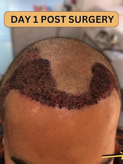 Day 1 post-surgery. The newly implanted grafts are visible. This is the very beginning of the healing and growth process.