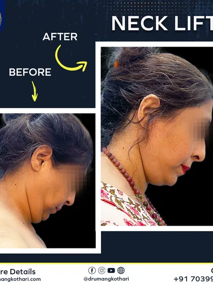 A defined jawline and smooth neck can dramatically change your profile. For this patient, a neck lift procedure removed the excess skin and fat under the chin. The result is a sharper, more youthful contour that looks completely natural.