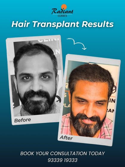 Here, we addressed both a receding hairline and thinning throughout the top. The 'after' photo shows the powerful impact of expert precision in creating a fuller, more robust look.