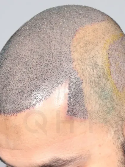 For this Norwood Grade 6 patient, we used 5500 grafts to provide complete coverage, recreating the hairline, frontal part, mid-scalp, crown, and temples.