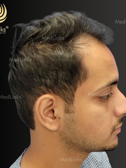 The patient's hair from the side before the procedure.