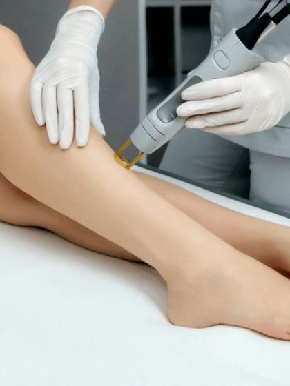 This photo shows a laser hair removal treatment on the lower legs. It is an ideal solution for anyone looking to say goodbye to the daily hassle of shaving and enjoy the confidence of smooth, hair free legs.