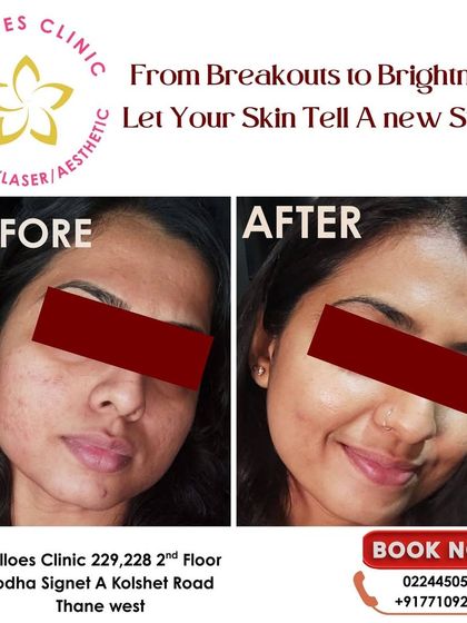 From breakouts to brightness, this transformation is a testament to what consistent, expert-led dermatological care can achieve. I customize every plan to the individual's skin story.