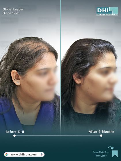 Another side-profile view of the 6-month result. This angle highlights the expertly crafted hairline that blends seamlessly with her features, showcasing the artistic skill of our DHI surgeons.