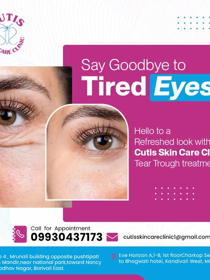 A targeted before-and-after result from our Tear Trough treatment. This visual effectively shows the reduction of under-eye hollows and wrinkles, creating a refreshed and less tired appearance.