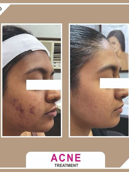 Another successful acne treatment journey. We focused on reducing inflammation and preventing new breakouts while simultaneously working on the texture and marks left by previous ones.