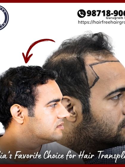 This image shows a 6-month result of a 4918 graft procedure. It highlights the rebuilt hairline and temple zones, demonstrating how we can achieve an age-matched, natural look.