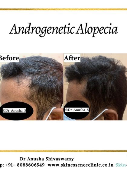Anusha Shivaswamy - Hair Restoration & Scalp Treatments Hair Regrowth Results photo 3