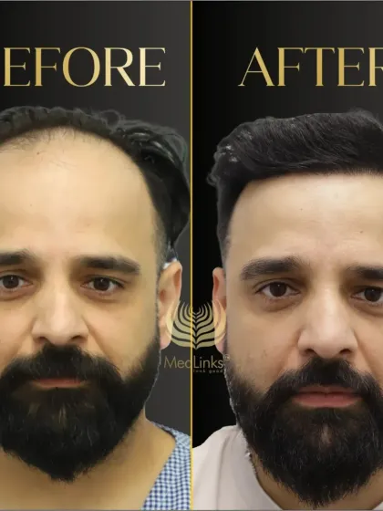 This before and after comparison highlights the dramatic improvement in hair density and hairline design. The result is a completely revitalized and more youthful appearance.
