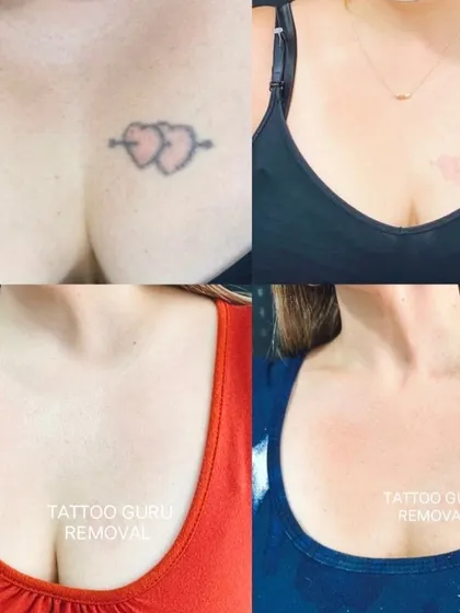Fading colored tattoos, especially reds, can be challenging but it is possible. This collage shows the progress of removing two hearts from the chest area, resulting in much clearer skin over several sessions.