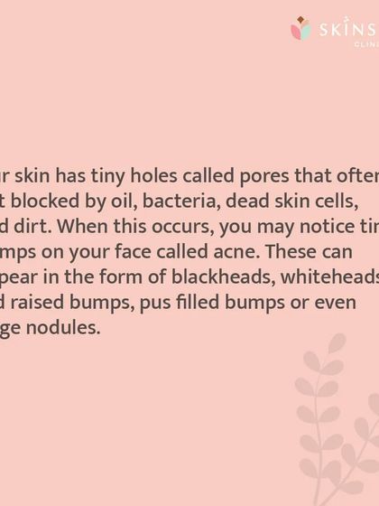 This graphic details the process of how a pimple forms. Understanding this helps in realizing why surface treatments alone are often not enough and a deeper, clinical approach is needed.