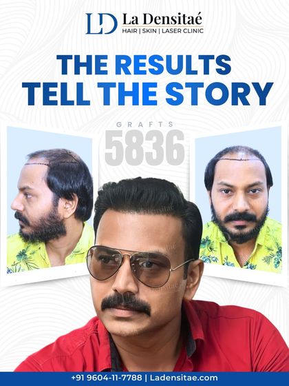 Actor Pramod Mani once struggled with hair loss and self-doubt. Now, he confidently flaunts a natural-looking hairline after a successful hair transplant of 5,836 grafts at my clinic.