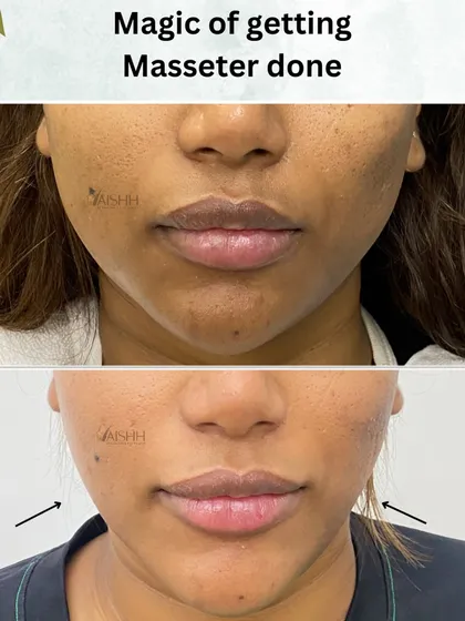 A strong, defined jawline can significantly enhance facial structure. This before and after shows the effect of a masseter treatment, which slims the lower face for a more V-shaped and contoured profile without surgery.