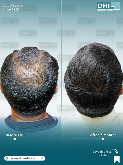 This top-down before and after shot provides a clear view of the significant crown coverage achieved for this client after 7 months. Our DHI technique ensures excellent density even in advanced hair loss cases.