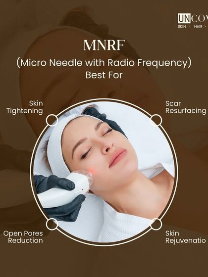 MNRF, or Microneedle with Radio Frequency, is one of our best treatments for skin tightening, scar resurfacing, open pore reduction, and overall skin rejuvenation.