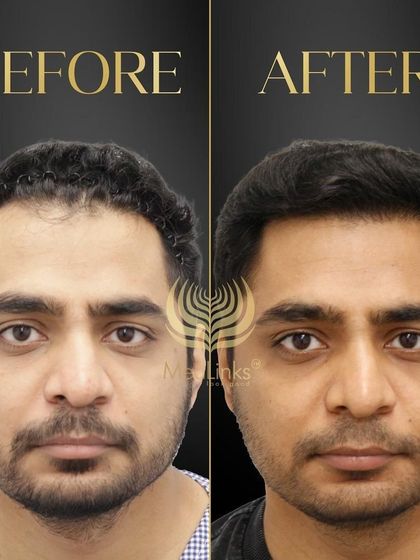 This before and after comparison shows a dramatic improvement in hair density and hairline. The patient looks younger and more confident.