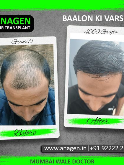 We call this "Baalon ki Varsha" or a shower of hair. This 4000 graft transplant effectively covered this patient's Grade 5 baldness, giving him a dense and youthful head of hair.