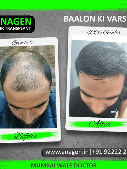 "Baalon ki Varsha" (A shower of hair). This Grade 5 baldness case was treated with 4000 grafts, resulting in a remarkable downpour of new, dense hair growth.