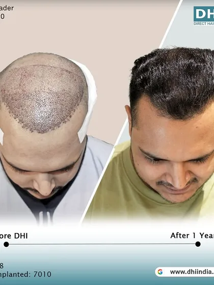 This image shows the client's head immediately after the procedure compared to the one-year result. It provides a transparent look at the process and the incredible growth achieved.