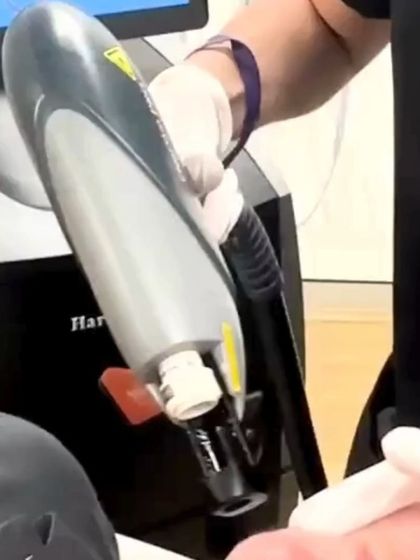 A close-up of the Alma Harmony laser handpiece. This advanced technology is used to target and treat imperfections like acne scars, pigmentation, and signs of aging for rejuvenated skin.