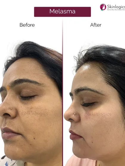 This side view of a patient treated for melasma shows the significant fading of dark patches on the cheek. The skin texture also appears smoother and more radiant post-treatment.