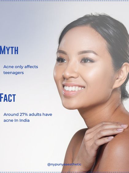 Myth: Acne only affects teenagers. Fact: Around 27% of adults in India struggle with acne due to factors like hormones, stress, and diet.