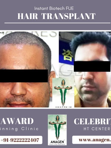 This before and after photo shows the result of an Instant Biotech FUE transplant, with the patient achieving a much fuller head of hair.