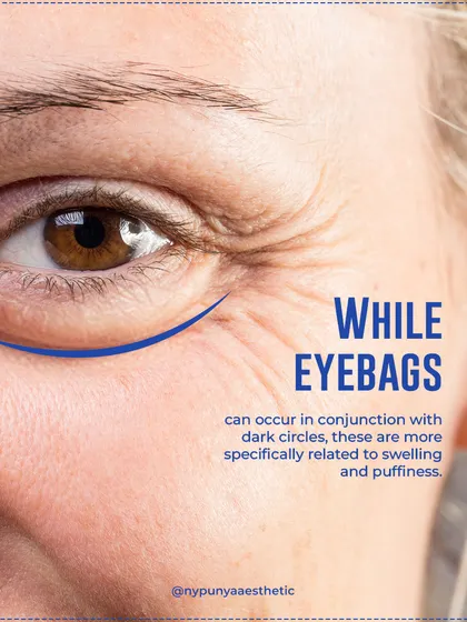 Eye bags and dark circles are different issues with different solutions. Dark circles are often pigmentation-related, while eye bags are about swelling and require a different treatment approach.