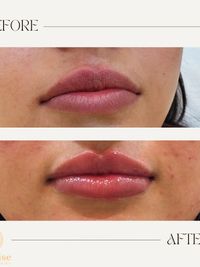 Cosmetic Injectables & Anti-Aging