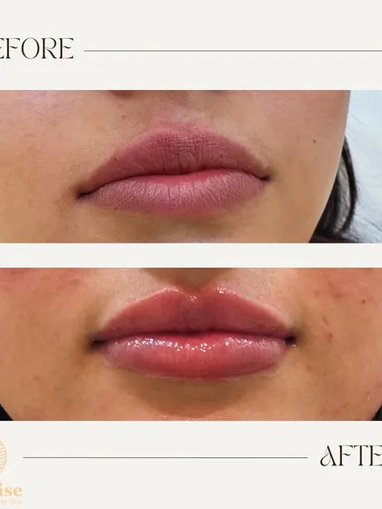 A perfect example of my philosophy on lip fillers: enhancement, not exaggeration. Here, I focused on adding subtle volume and hydration to create a beautifully balanced and natural-looking pout.