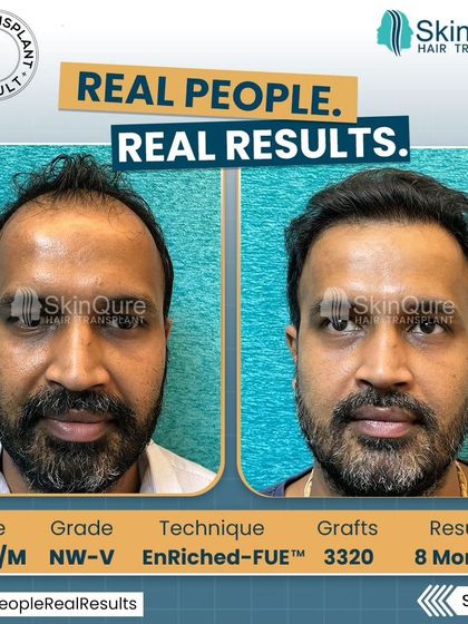 A frontal view of the 36-year-old patient with Norwood Grade V baldness. The 8-month result after 3320 grafts shows a dramatic improvement, restoring a youthful and confident appearance.