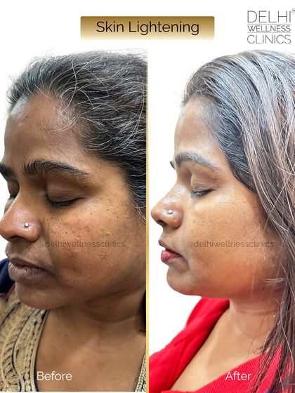 A side profile showcasing the beautiful, even-toned results from our skin lightening treatment, which helps restore the skin's natural radiance.