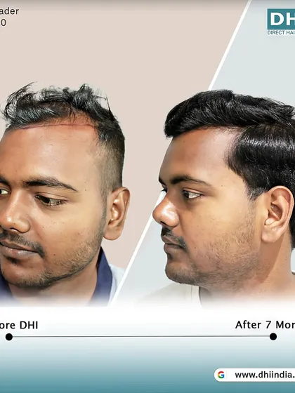 Another side-profile view of the 7-month result. This angle showcases the natural flow and density of the newly implanted hair, blending seamlessly with his existing hair.