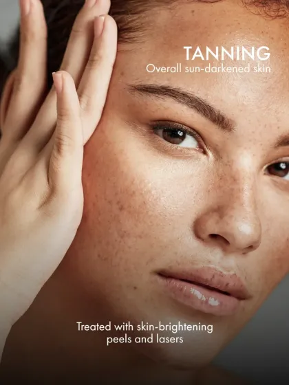 Tanning is an overall darkening of the skin caused by sun exposure. To reverse this, I use skin-brightening chemical peels and specific laser treatments to restore your natural skin tone.