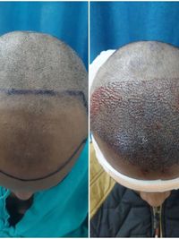 Hair Restoration