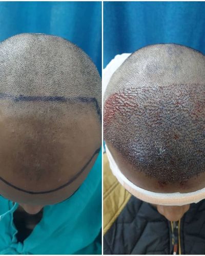 Hair Restoration
