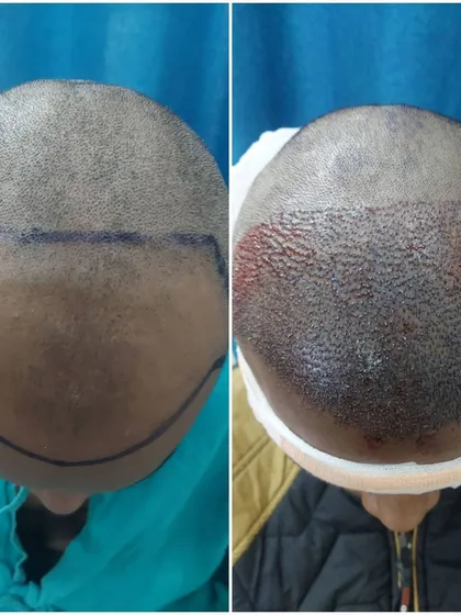 An overhead view comparing the scalp before and immediately after the FUE hair transplant, showing the extensive coverage achieved in a single session.